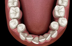 Illustration of crooked teeth
