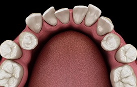 Illustration of gapped teeth