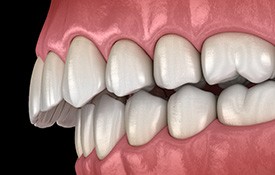 Illustration of an overbite