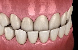Illustration of an underbite