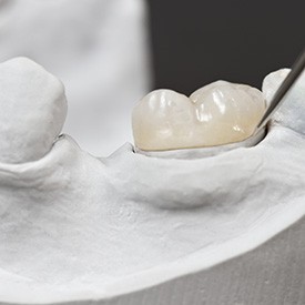  Closeup of a dental crown on a plaster model arch of teeth