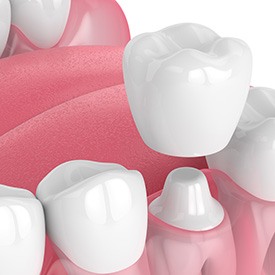 Illustration of a dental crown levitating over an abutment tooth on a lower arch with white background