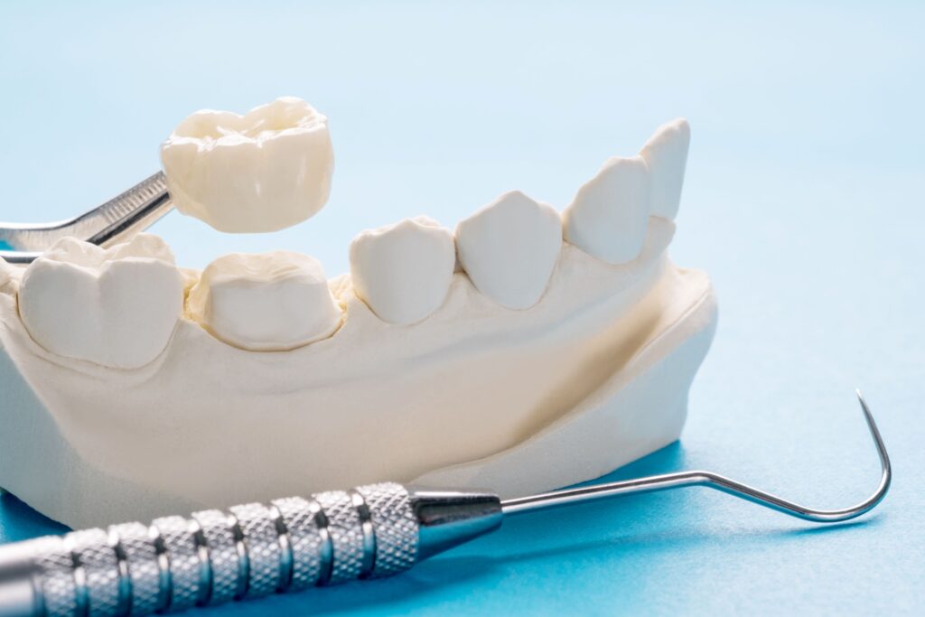 Dental crown being placed over cast of lower teeth with dental instruments on a blue surface