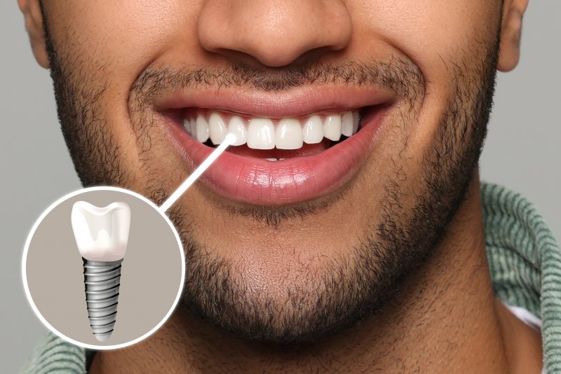 a man smiling with a dental implant